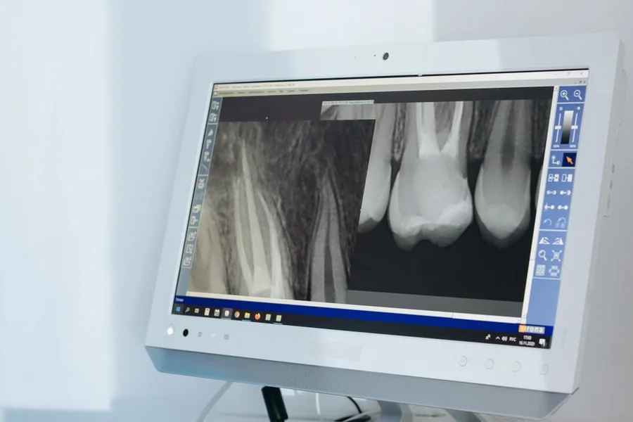 Dental Radiograph Detail Close-up dental radiograph showing teeth, the image type AI scans to detect cavities